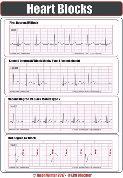 Ekg Practice Strips Printable - Printable Word Searches