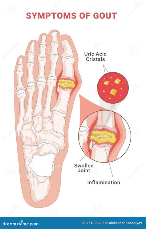 Symptoms of Gout Infographic Scheme Vector Flat Human Foot with Crystallization of Uric Acid ...