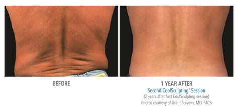 CoolSculpting Knees Before and After Photos