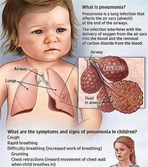 What Is Pneumonia, Signs Of Pneumonia, Pneumonia In Kids, Lung Infection, Infections, Kids Cough ...