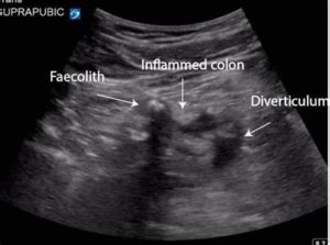 Imaging for Diverticulitis | Ultrasound Solutions Corp.