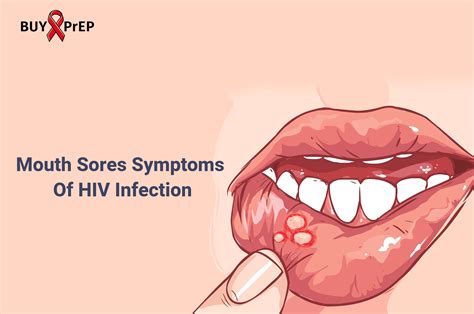 Mouth Sores Symptoms Of HIV Infection - Buy PrEP