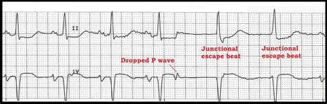 Float Nurse: Practice ECG Rhythm Strips 114