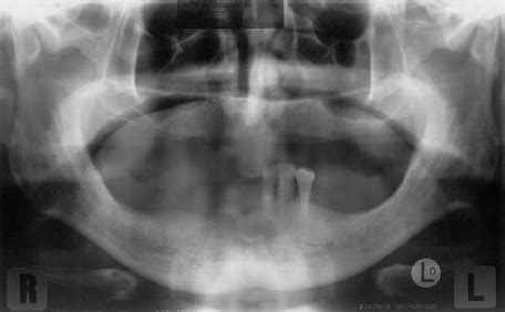 Preoperative panoramic x-ray. | Download Scientific Diagram