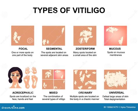 Infographics Of Vitiligo. Symptoms Of The Disease. Abstract Woman ...