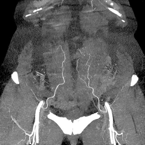 Figure 1 from Analysis of deep inferior epigastric artery perforating vessels with CT ...