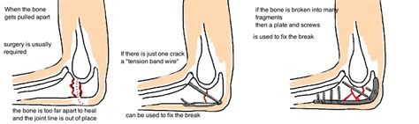 Elbow - Olecranon Fracture (Broken Elbow) — Bone Talks