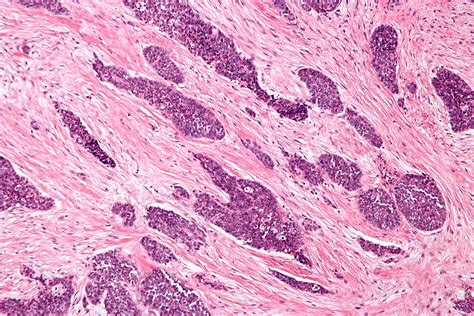 File:Desmoplastic small round cell tumour - intermed mag.jpg - Wikipedia