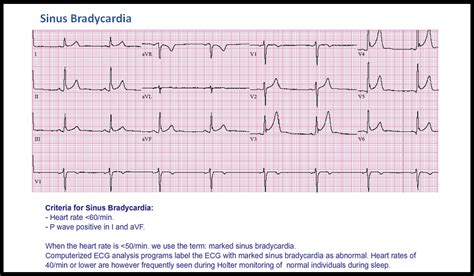 T20: Sinus Bradycardia - ECG Made Simple