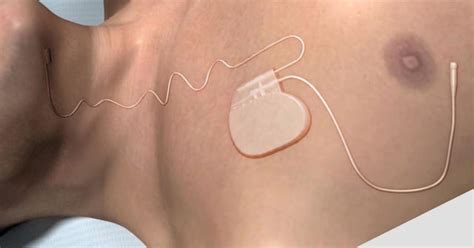 New sleep apnea device gets FDA approval - CBS News