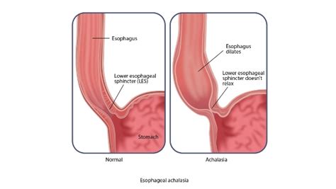 Laparoscopic Heller Myotomy (Cardiomyotomy)