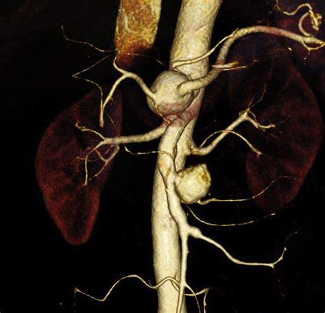 Endovascular treatment of coexistent superior mesenteric artery aneurysm and celiac artery ...