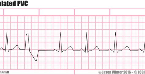 ECG Educator Blog : Premature Ventricular Contraction (PVC)