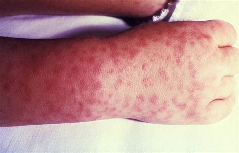 Lyme Disease Tick Bite Rash