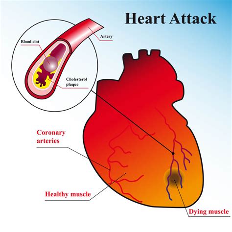 Chest Pain and Heart Attack - Here Is What You Do - Dr Vivek Baliga, HeartSense