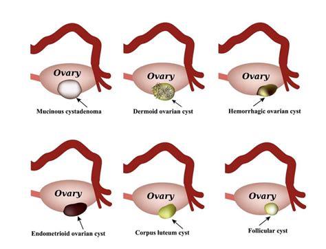 Can Depo Shot Cause Ovarian Cysts – Coach M Morris