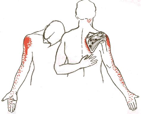 Aggressively Modified: Anterior Deltoid Shoulder Pain: Infraspinatus ...