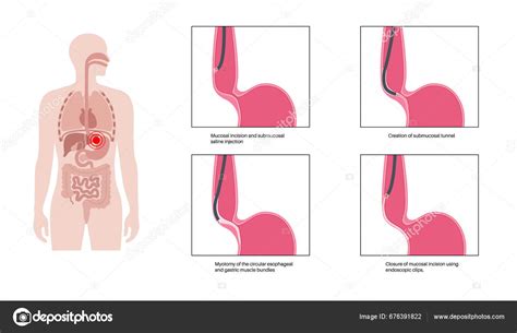 Peroral Endoscopic Myotomy Poem Minimally Invasive Procedure Disorder Esophagus Achalasia Stock ...