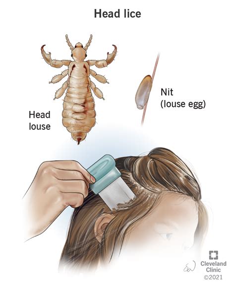 Head Lice Signs, Symptoms, Causes & Treatment