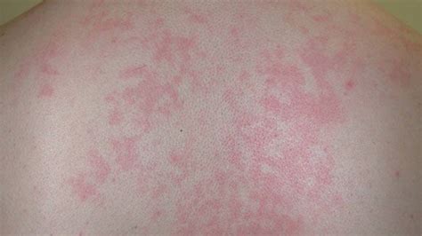 Rash and Sore Throat: Pictures, Causes, and Treatments