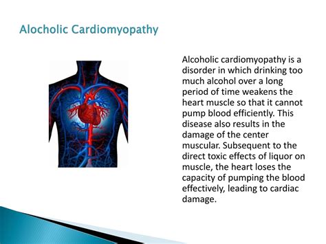 PPT - Alcoholic Cardiomyopathy PowerPoint Presentation, free download - ID:1280694