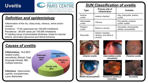 Uveitis Intermedia