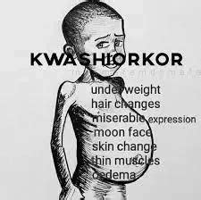 Causes of Kwashiorkor Archives - Proguide