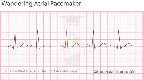 ECG Educator Blog : Atrial Rhythms