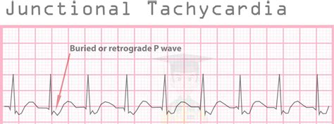 Junctional Tachycardia Vs Svt