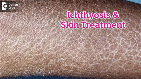 What is Ichthyosis? How to Treat my Skin?| Fish like scales On Skin-Dr.Rasya Dixit | Doctors ...