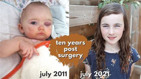 ten years after surgery: SAGITTAL CRANIOSYNOSTOSIS - YouTube