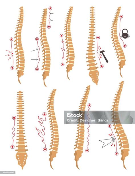 Spinal Deformity Types Symbols Of Spine Curvatures Or Unhealthy Backbones Human Spine Anatomy ...