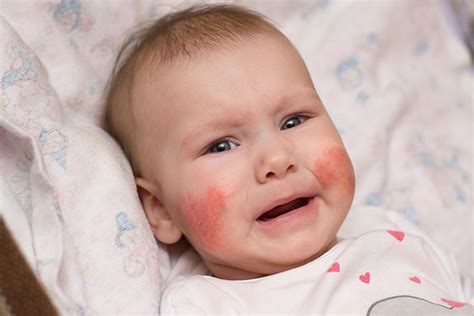 5 Types Of Skin Allergies In Babies, Treatment & Prevention