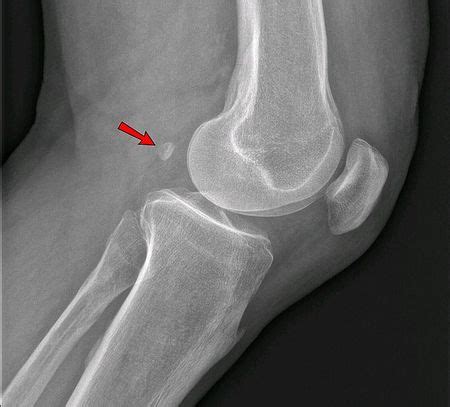 Fabella syndrome - Physiopedia