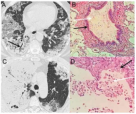 Comparison of CT findings and pathology (A) Black arrow indicates the ...