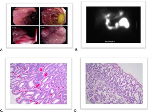 Bile reflux of the remnant stomach following Roux-en-Y gastric bypass ...