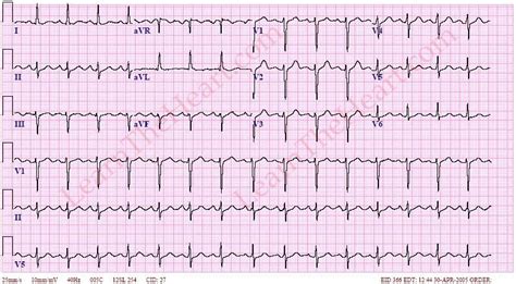 Left Axis Deviation (Example) | Learn the Heart