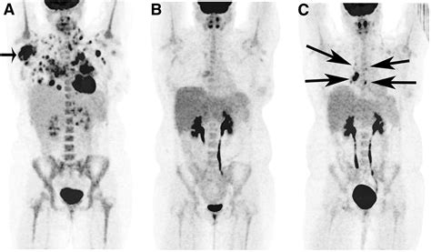 The Role of PET and PET/CT in Managing the Care of Lymphoma Patients | Journal of Nuclear ...