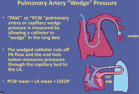 Pulmonary Capillary Pressure And Pulmonary Capillary Wedge, 50% OFF