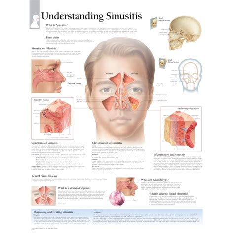 Sinusitis, Sinus infection, Back pain remedies