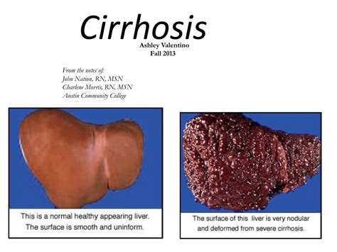 Liver Cirrhosis Ppt