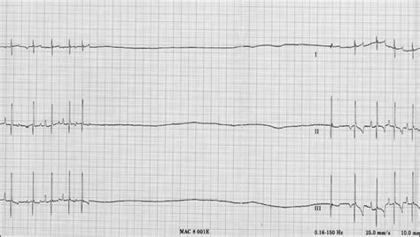 ECG Interpretation