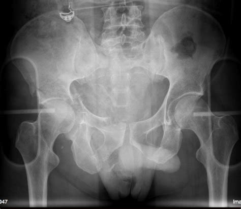 Pelvic Fracture – Undergraduate Diagnostic Imaging Fundamentals