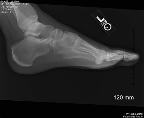 File:X-ray foot 2.jpg - Wikimedia Commons