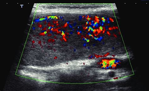 Ultrasound of the thyroid showing an intense vascularity on color ...