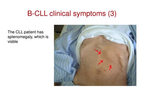 PPT - The Chronic Lymphocytic Leukemia (CLL) PowerPoint Presentation, free download - ID:3275647