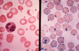 USMLE Pathology Slides - PB on the left and special supravital stain on the...