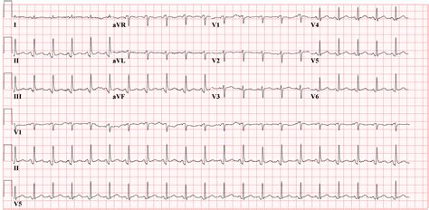 Pericarditis EKG examples - wikidoc