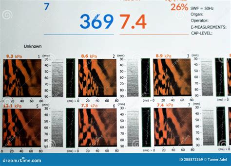 Fibroscan Examination Study Of The Liver Revealed F2 For Liver ...