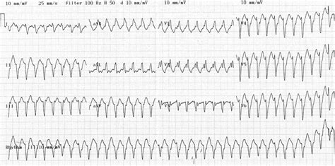 Ventricular Tachycardia – Monomorphic VT • LITFL • ECG Library